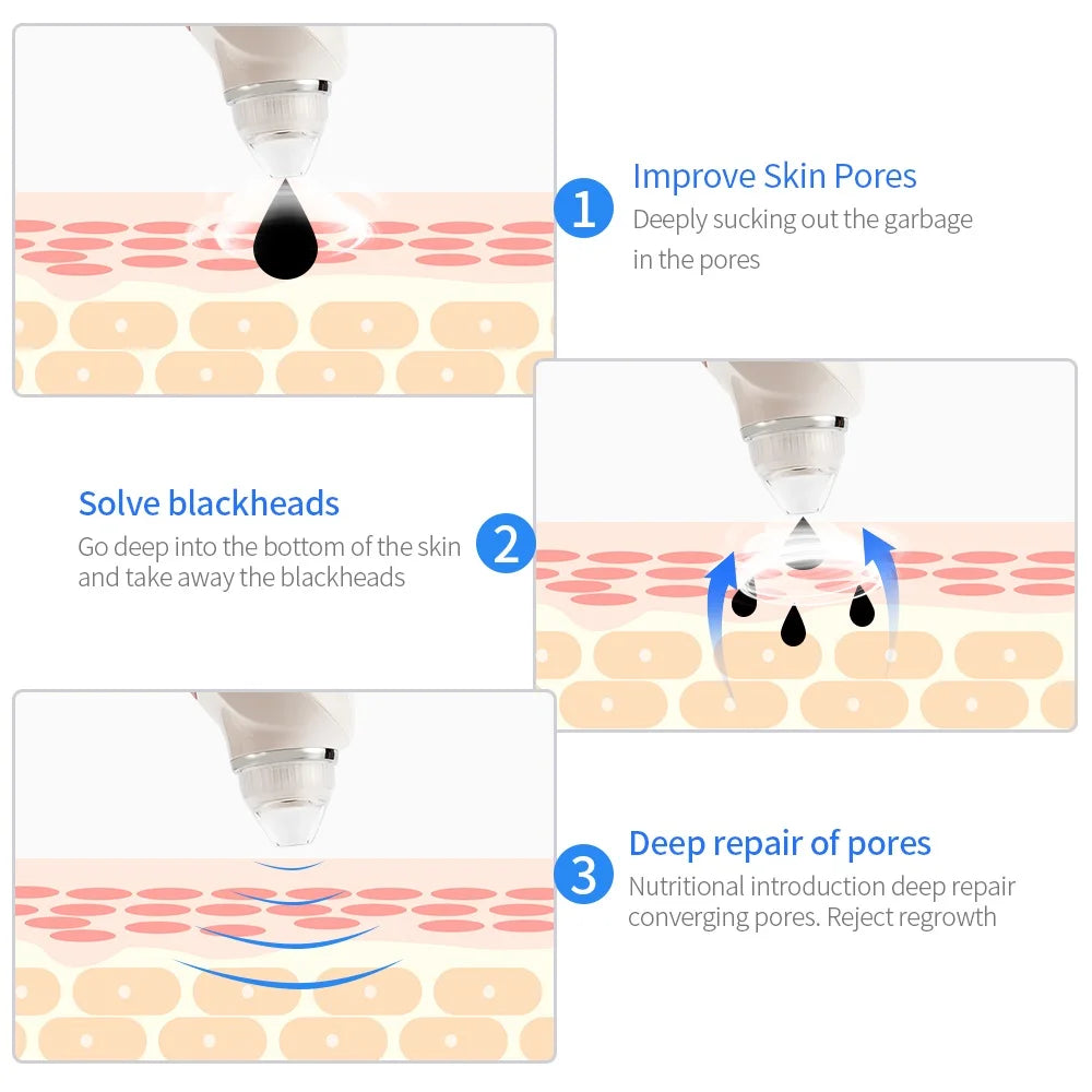 Blackhead Remover with Camera – HD Pore Cleaner Tool