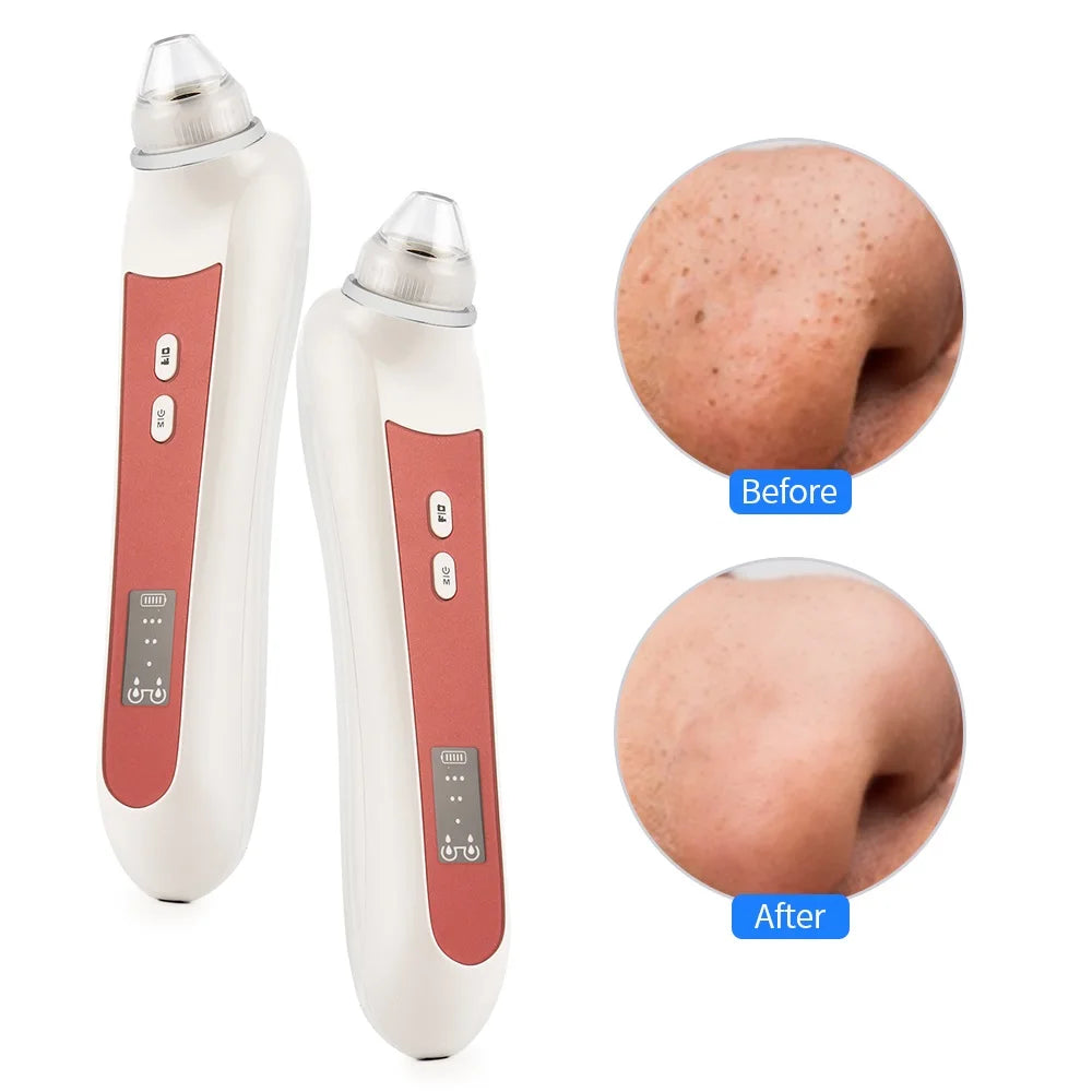 Blackhead Remover with Camera – HD Pore Cleaner Tool